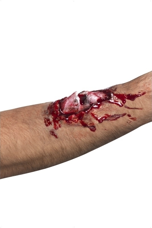 Rana falsa - Fractura deschisa Antebrat, #1, Carnaval24